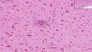 Histopathology Brain Viral encephalitis [upl. by Geraint566]