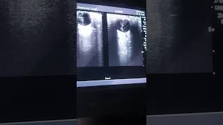 B Scan  ultrasound eye vitreous hemorrhage [upl. by Luce]