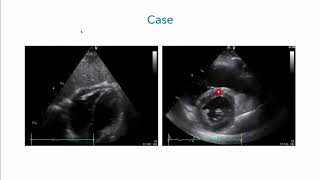 An Athletes Battle with Constrictive Pericarditis [upl. by Hertzog]