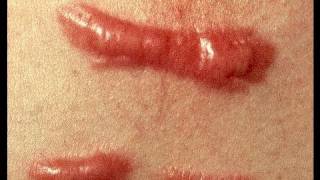 DermTV  How to Treat a Keloid Scar DermTVcom Epi 279 [upl. by Bridie288]