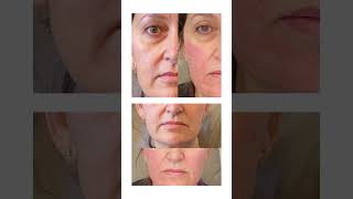 70 years looks 20 The best collagen works to erase all wrinkles from all over the face [upl. by Elwin]