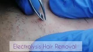 Electrolysis Permanent Hair Removal Face [upl. by Navets985]