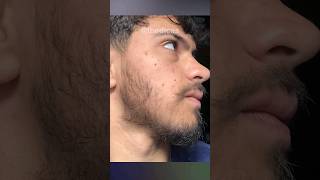 1 ANO E 5 MESES usando MINOXIDIL evolução com minoxidil barba minoxidil thedicas [upl. by Latimore]