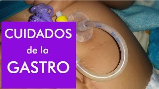 Gastrostomía  Lavado de sonda y como evitar taponamientos [upl. by Ynahirb53]