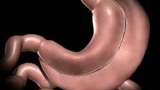 Laparoscopic Vertical Sleeve Gastrectomy by Marc Zare MD [upl. by Thorma]