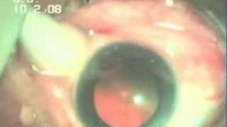 Intravitreal Injection Avastin In WET AMD Dr Sudhalkar [upl. by Ailama377]