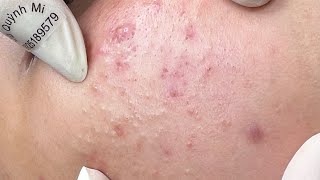 ACNE TREATMENT VU QUYNH MI Acne On Boys Chin 2024 [upl. by Rebmetpes]