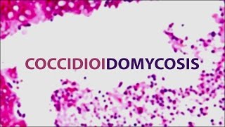 Coccidioidomycosis Valley Fever  Pediatric Grand Grounds  Mattel Childrens Hospital UCLA [upl. by Biegel300]