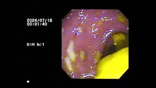 CL DIFFICILEPSEUDOMEMBRANOUS COLITIS [upl. by Mossolb806]