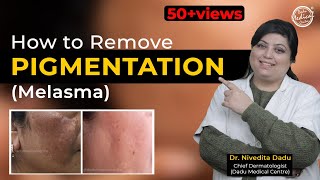 How To Cure Melasma  Latest Treatment For Melasma  Dr Nivedita Dadu [upl. by Margarida]