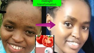 Tomato  colgate to remove pimples  how to remove blackspots and acne  how to smoothen your skin [upl. by Eedak149]