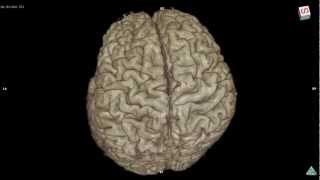 Variation of brain cortex 3D MRI sample Bgo [upl. by Alexandro]