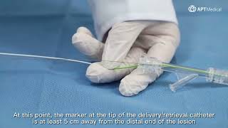 Demonstration of EmboCatcher™ Embolic Protection Device [upl. by Noillid561]