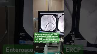 Enteroscopy assisted ERCPCBD is freeafter removal of CBD stonepatient with gastric bypass surgery [upl. by Pat]