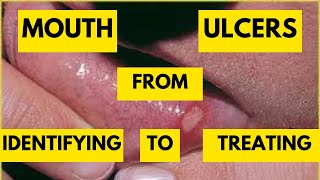 Mastering Recurrent Aphthous Stomatitis Most Common Mouth Ulcers and Effective Treatment Strategies [upl. by Alihet]