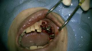 Straumann NC RN WN place in posterior mandible 4 [upl. by Simson624]