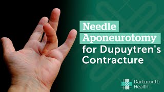 Needle Aponeurotomy for Dupuytrens Contracture [upl. by Nutter]