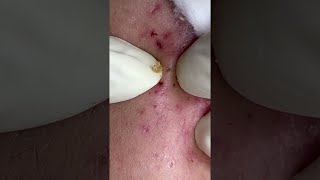 Big Cystic Acne Blackheads Extraction Blackheads amp Milia Whiteheads Removal Pimple Popping shorts [upl. by Parrisch]