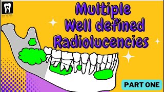 Multiple Separate Radiolucency With Well Defined Borders  Oral Radiology  Oral Pathology  OKC [upl. by Ecnarretal15]