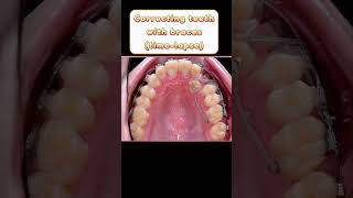 Correcting teeth with braces timelapse teethbraces orthodontics shorts [upl. by Latsirhc]