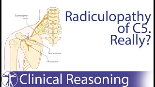 Suprascapular Nerve Entrapment mimicking C5 Radiculopathy [upl. by Nnaillek]