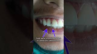 Mysterious Transformation of decayed toothComposite Restoration Front Tooth BeforeAfter filling [upl. by Sarene221]