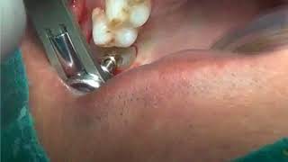 Gingivectomy for emergence profile with diamond bur [upl. by Callahan]