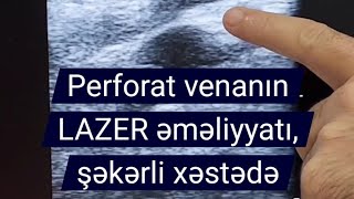 perforat vena perforant damar lazer ablasiya EVLA emeliyyat перфорантная вена лазерная абляция ЭВЛА [upl. by Attem]