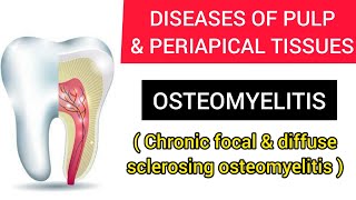 OSTEOMYELITIS CHRONIC FOCAL AND DIFFUSE SCLEROSING OSTEOMYELITIS [upl. by Suolevram]