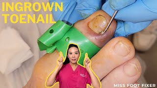 Effortless Ingrown Toenail Removal  PainFree Treatment In Minutes  Miss Foot Fixer [upl. by Baggott635]