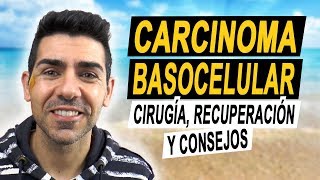 CARCINOMA BASOCELULAR  Operación recuperación y consejos tras tener un carcinoma basal en la cara [upl. by Ruhnke624]