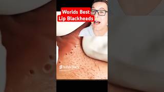 Worlds Best LIP BLACKHEAD REMOVAL shorts [upl. by Teufert]