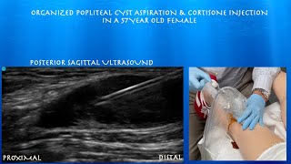 Ultrasound Guided Complex Popliteal Cyst Aspiration and Cortisone Injection by probeultrasound [upl. by Hbahsur]