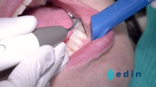 Ultrasoon reinigen bij parodontitis  Edin Dental Academy [upl. by Mich]