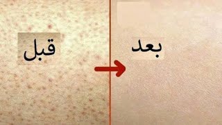 روتين علاج جلد الوزه من اول استخدام مرهم ديبروساليك وكارباميد [upl. by Thorlay522]