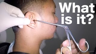 Foreign Body Stuck Deep in Mans Ear Finally Removed What is it [upl. by Enyalb]