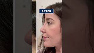 Rhinoplasty Before and After  Nose Job in Turkey  Rhinoplasty Surgeon [upl. by Lennox]