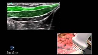 How To Ilioinguinal and Iliohypogastric Regional Nerve Block 3D Video [upl. by Eillac]