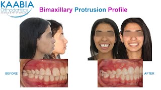 Severe Bimaxillary protrusion  convexe profile Biproalvéolie sévère  profil convexe [upl. by Wamsley157]