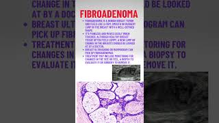 Fibroadenoma pathologyacademy draditikumar mbbs neet neetpg [upl. by Marshall115]