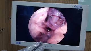 Endoscopic Transorbital Approach [upl. by Latia]