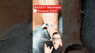 Stunning HUGE BLACKHEAD REMOVAL  Biggest Blackhead 2024 shorts [upl. by Lesser]