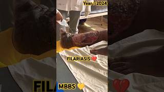 🧑🏻‍🔬FILARIASIS 💔mbbsdoctorfilariasisjoharimbbsneetmbbmbbsdairiesdiseasecancerlifestylepw🪷 [upl. by Tannenbaum86]