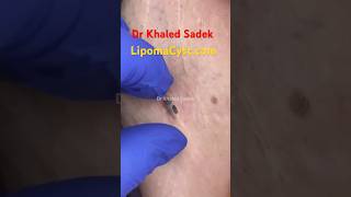 Massive blackhead extraction Dr Khaled Sadek blackheadremoval blackheads skincare [upl. by Fridlund524]