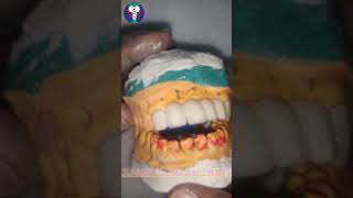 Teeth Set  Porcelain Bridge  Anterior  Dentin Firing Stage  Tamil Dental Lab  dentaltreatment🦷 [upl. by Goldenberg]