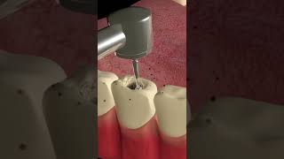 Dental Crown Procedure at the Dentist dentist dentalcrowns dentalcrown [upl. by Ahsekal]