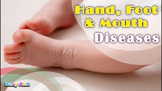 Hand Foot and Mouth Disease  Treatment of Hand Foot amp Mouth Disease Treatment and When to Worry [upl. by Munshi]