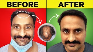 How I Changed My Life Completely Norwood 6 Hair Transplant [upl. by Takken]