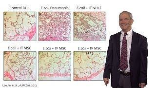 Bench to Bedside Mesenchymal Stem Cells and ARDS Part 2  Michael Matthay [upl. by Bueschel]