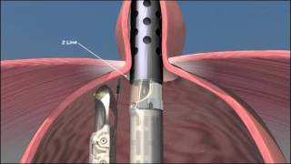 Acid reflux surgery  EsophyX animation [upl. by Turro]